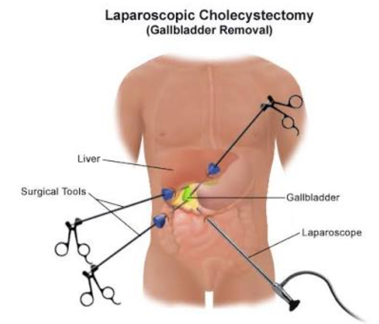 Gall Bladder Surgery