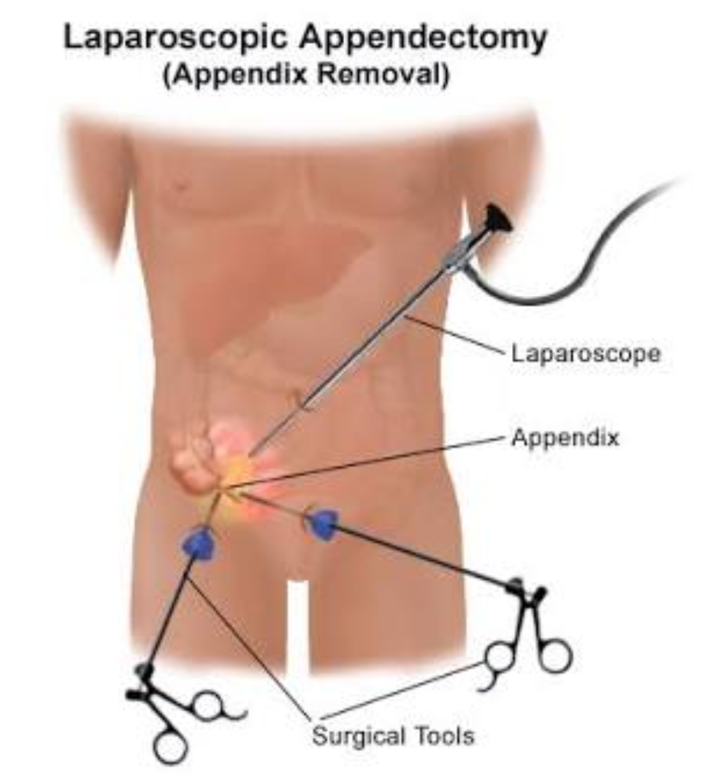 Lap Appendix Surgery
