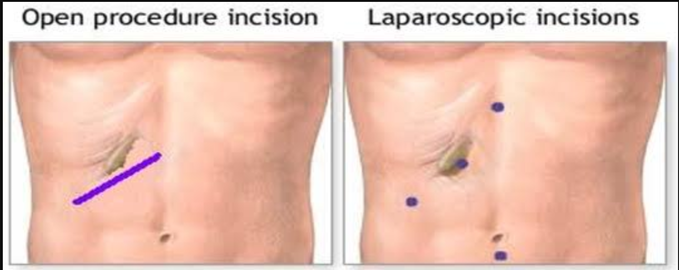 LAP GI Surgeries