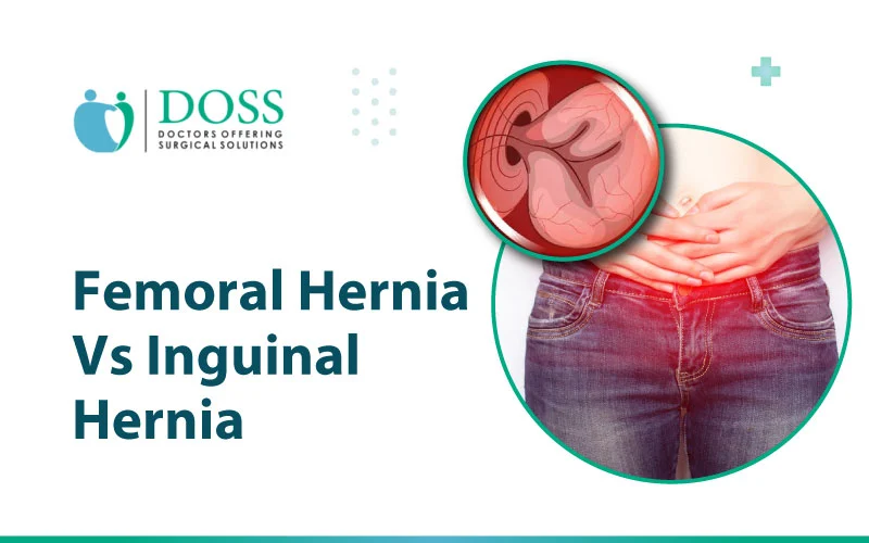 https://www.dossindia.com/wp-content/uploads/2024/03/Femoral-Hernia-vs-Inguinal-Hernia.webp